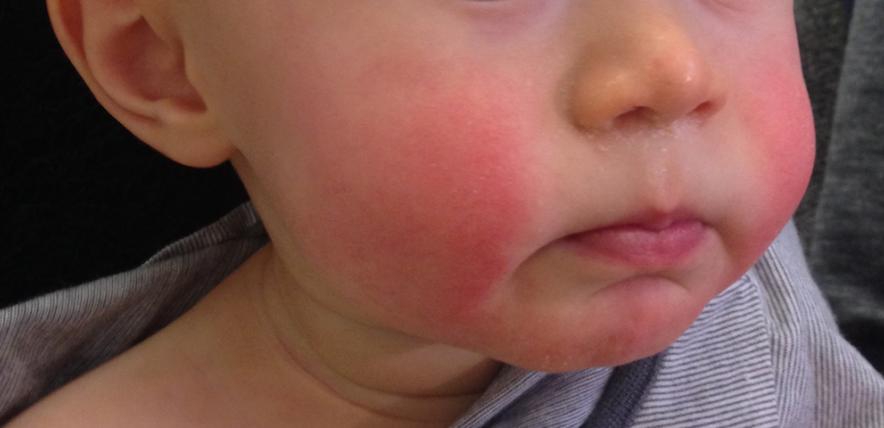 What is slapped cheek syndrome? | Family Corner