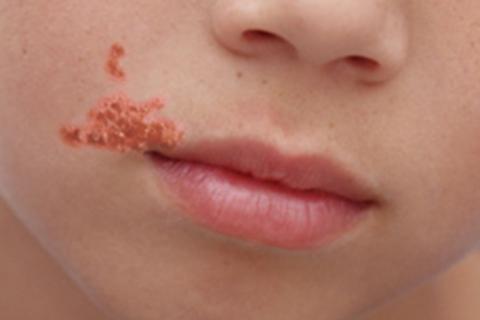 A child with impetigo near his mouth