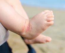 Baby foot with eczema