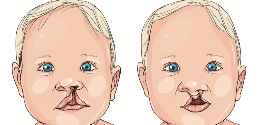 Cleft lip and/or palate in children | Family Corner