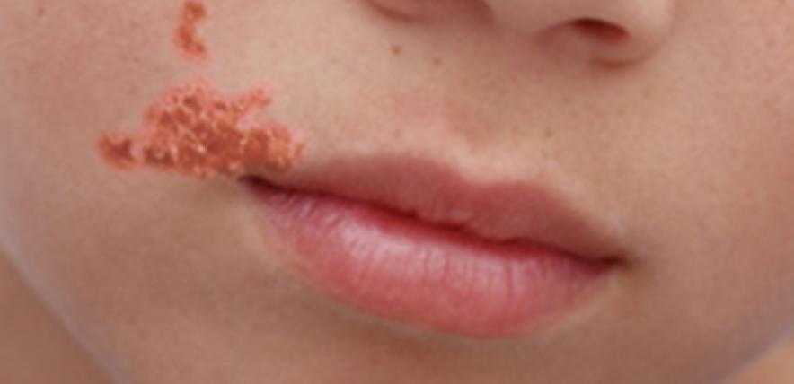 A child with impetigo near his mouth